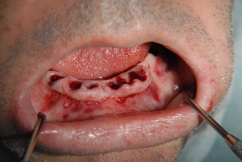 4. Stan po usunięciu zębów w żuchwie